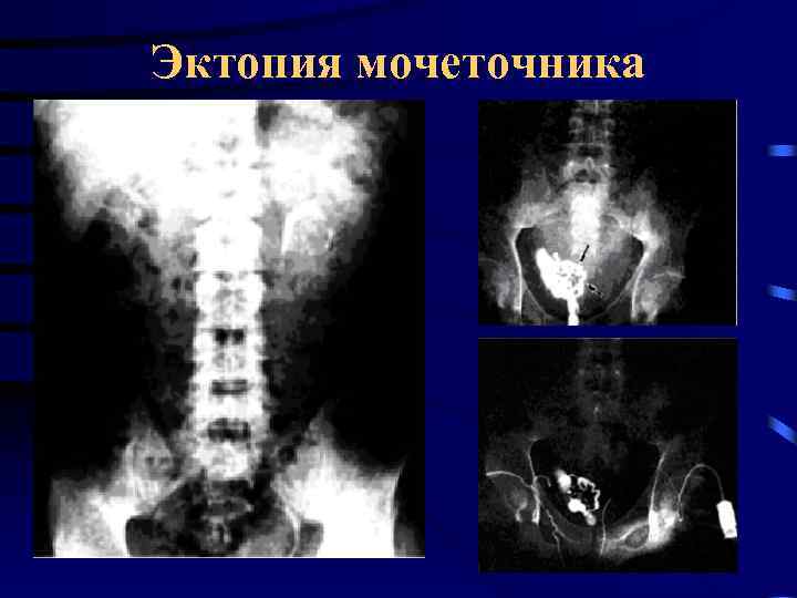 Эктопия мочеточника 