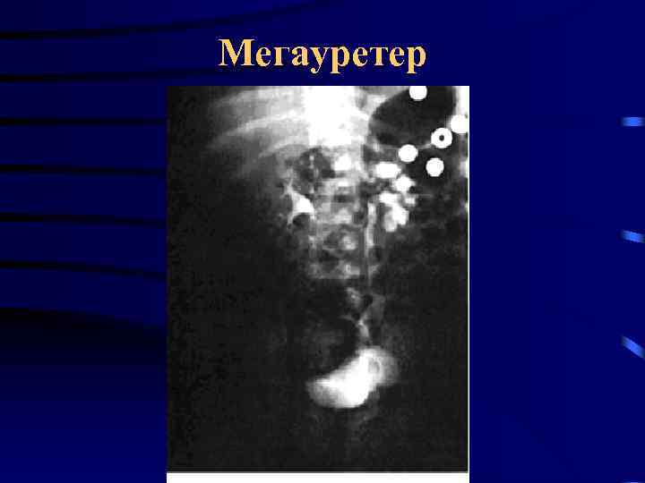 Мегауретер 