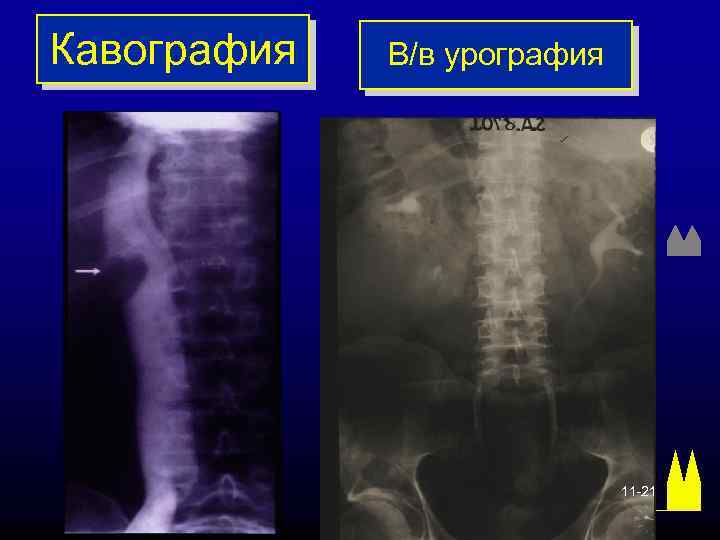 Кавография В/в урография 11 -21 