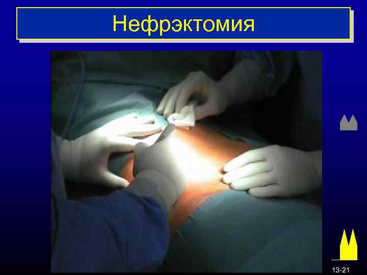 Нефрэктомия 13 -21 