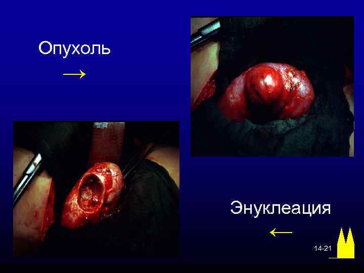 Опухоль → Энуклеация ← 14 -21 