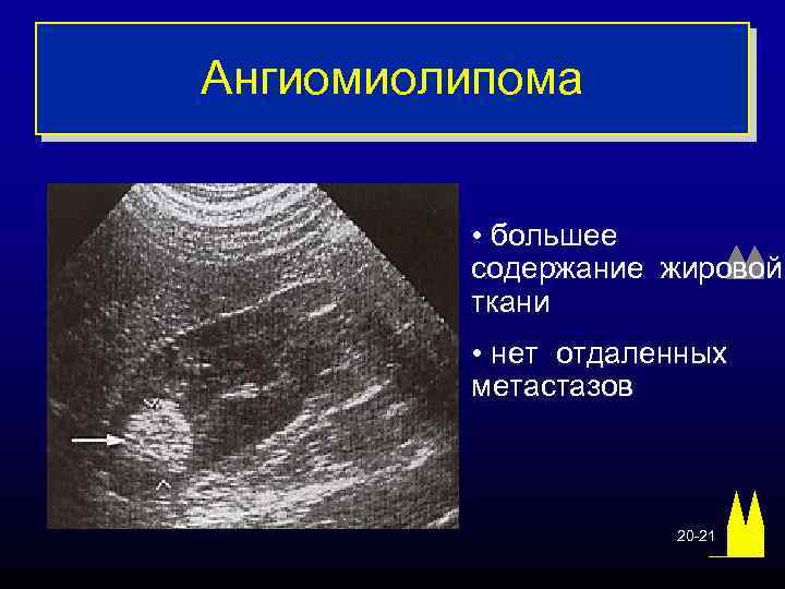 Ангиомиолипома • большее содержание жировой ткани • нет отдаленных метастазов 20 -21 