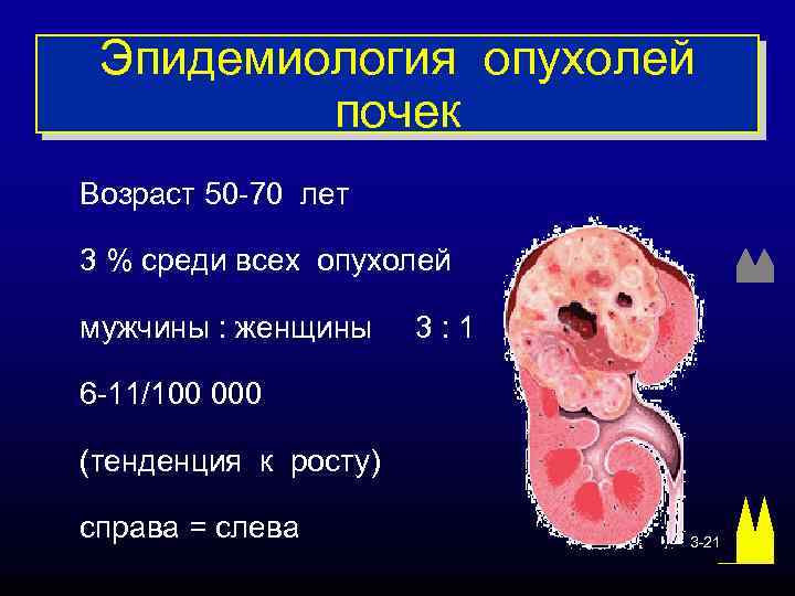 Эпидемиология опухолей почек Возраст 50 -70 лет 3 % среди всех опухолей мужчины :
