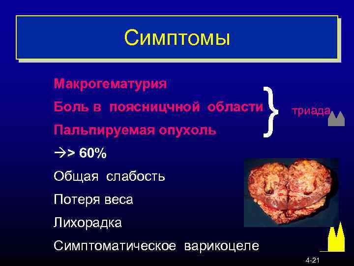 Симптомы Макрогематурия } Боль в поясницчной области Пальпируемая опухоль триада à> 60% Общая слабость