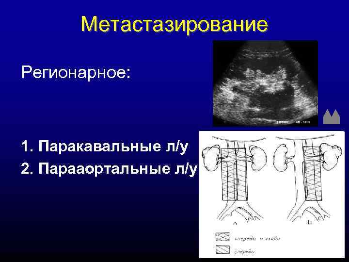 Метастазирование Регионарное: 1. Паракавальные л/у 2. Парааортальные л/у 