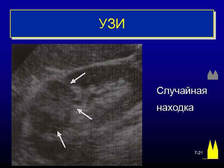 УЗИ Случайная находка 7 -21 