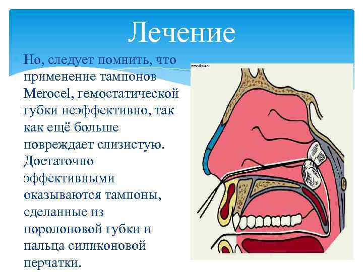 Лечение Но, следует помнить, что применение тампонов Merocel, гемостатической губки неэффективно, так как ещё