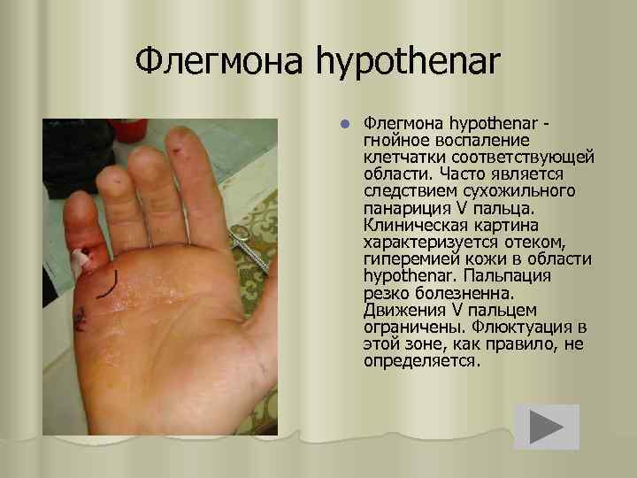 Флегмона hypothenar l Флегмона hypothenar гнойное воспаление клетчатки соответствующей области. Часто является следствием сухожильного