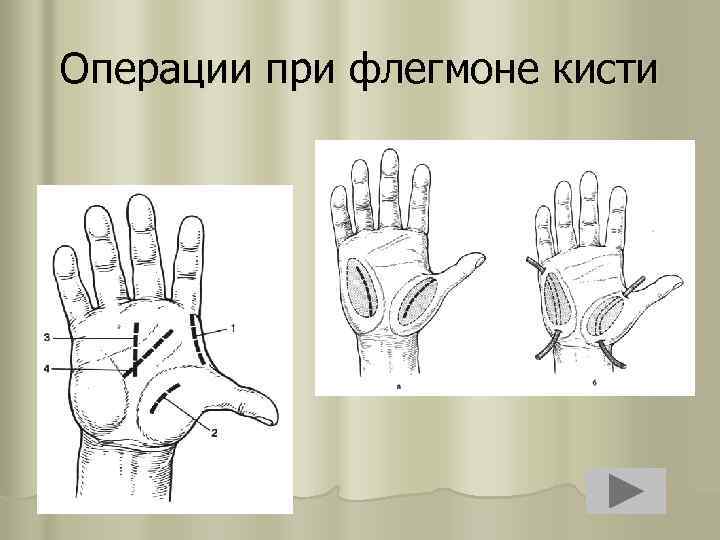 Операции при флегмоне кисти 