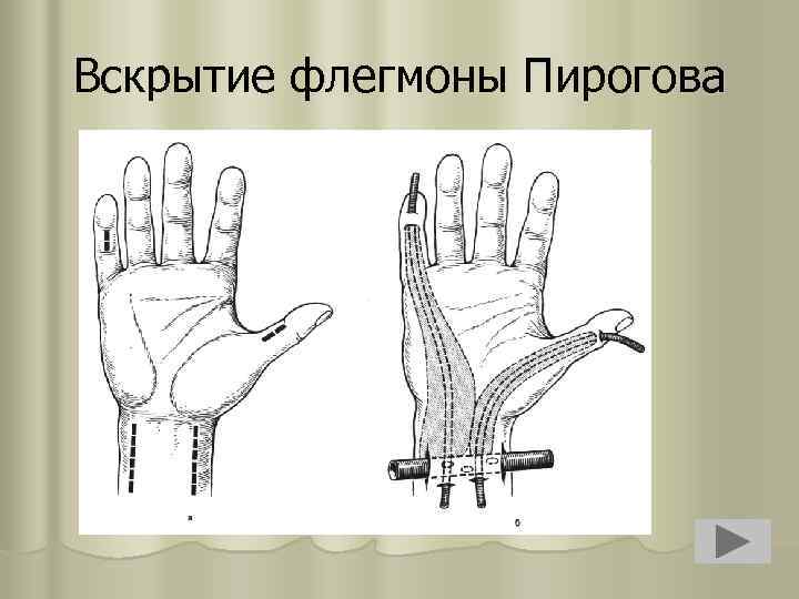 Вскрытие флегмоны Пирогова 