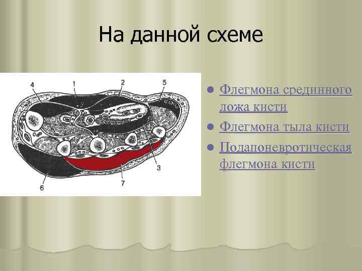 На данной схеме Флегмона срединного ложа кисти l Флегмона тыла кисти l Подапоневротическая флегмона