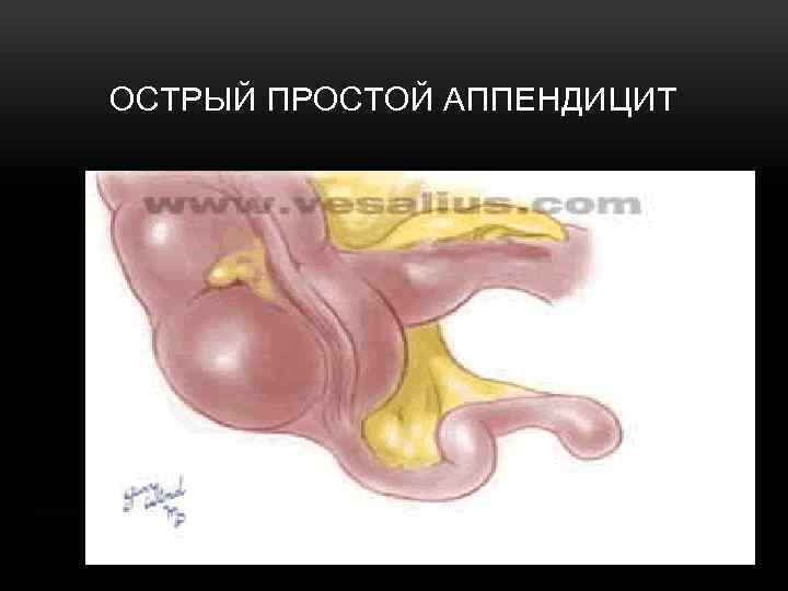 ОСТРЫЙ ПРОСТОЙ АППЕНДИЦИТ 
