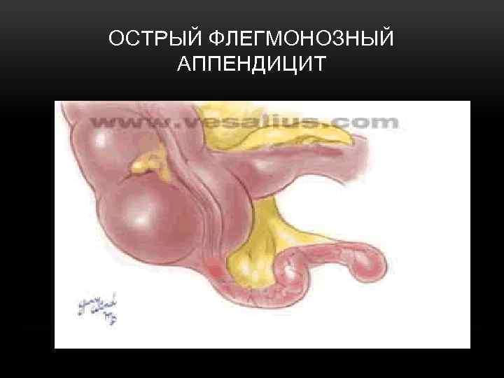 ОСТРЫЙ ФЛЕГМОНОЗНЫЙ АППЕНДИЦИТ 