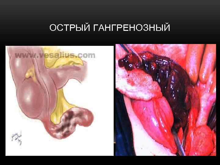 ОСТРЫЙ ГАНГРЕНОЗНЫЙ 