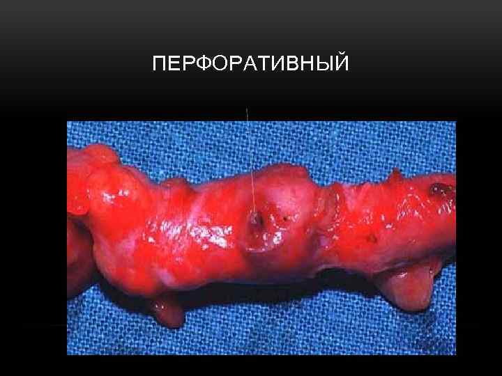 ПЕРФОРАТИВНЫЙ 