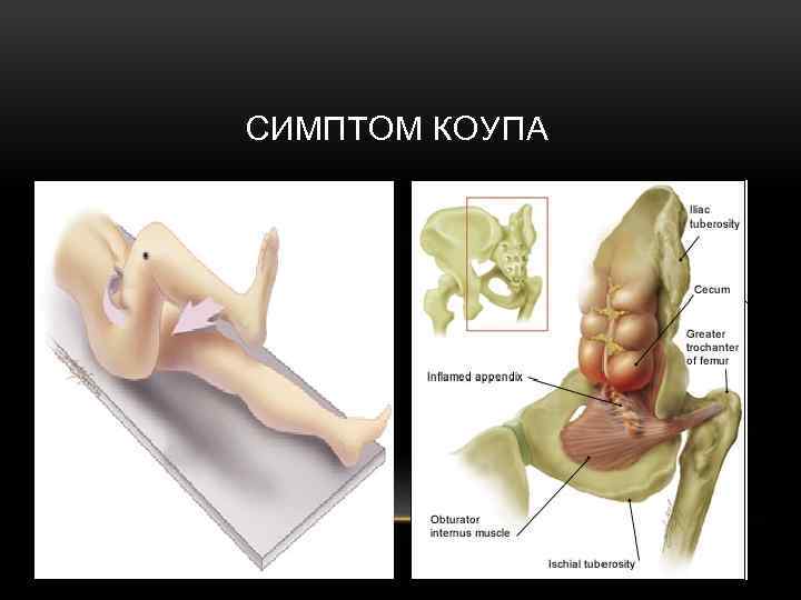 СИМПТОМ КОУПА 