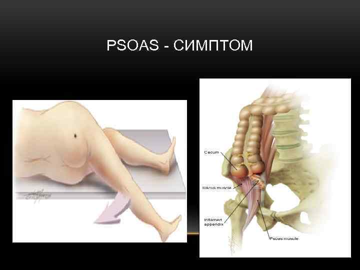 PSOAS СИМПТОМ 