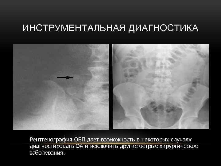 ИНСТРУМЕНТАЛЬНАЯ ДИАГНОСТИКА Рентгенография ОБП дает возможность в некоторых случаях диагностировать ОА и исключить другие