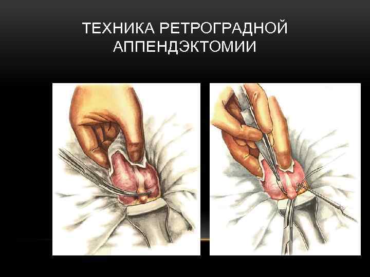 ТЕХНИКА РЕТРОГРАДНОЙ АППЕНДЭКТОМИИ 