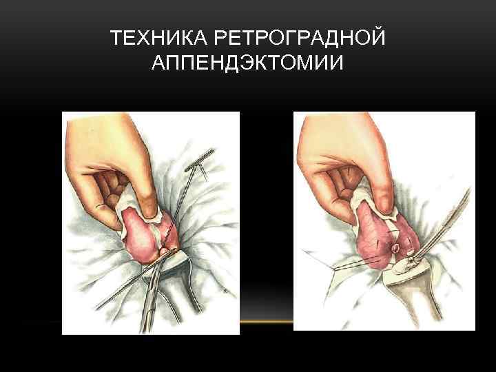 ТЕХНИКА РЕТРОГРАДНОЙ АППЕНДЭКТОМИИ 