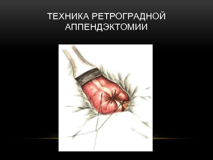 ТЕХНИКА РЕТРОГРАДНОЙ АППЕНДЭКТОМИИ 