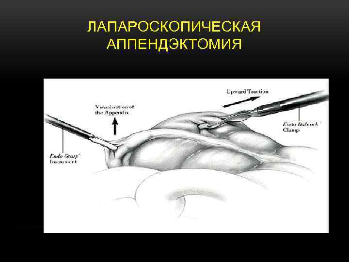 ЛАПАРОСКОПИЧЕСКАЯ АППЕНДЭКТОМИЯ 