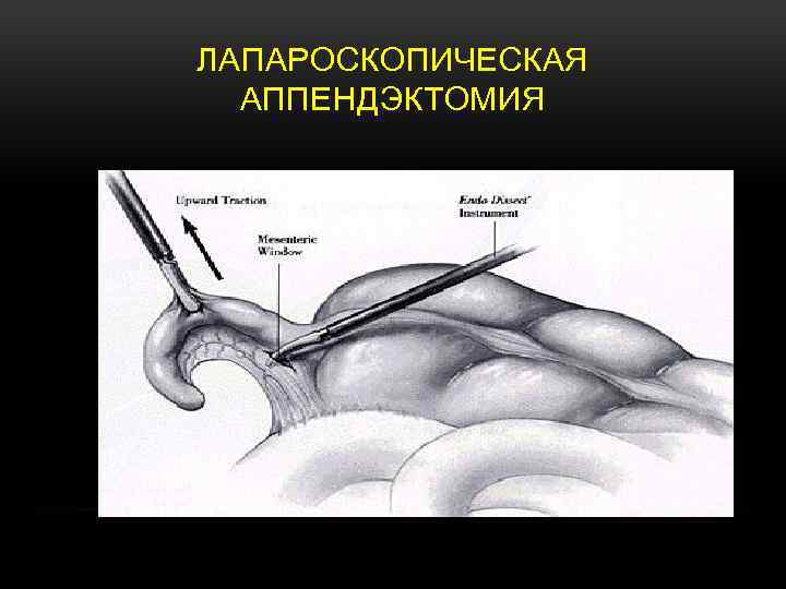 ЛАПАРОСКОПИЧЕСКАЯ АППЕНДЭКТОМИЯ 