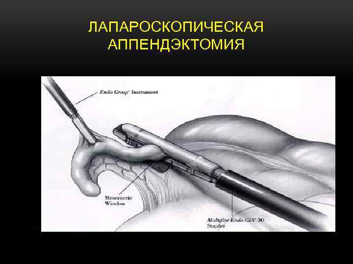 ЛАПАРОСКОПИЧЕСКАЯ АППЕНДЭКТОМИЯ 