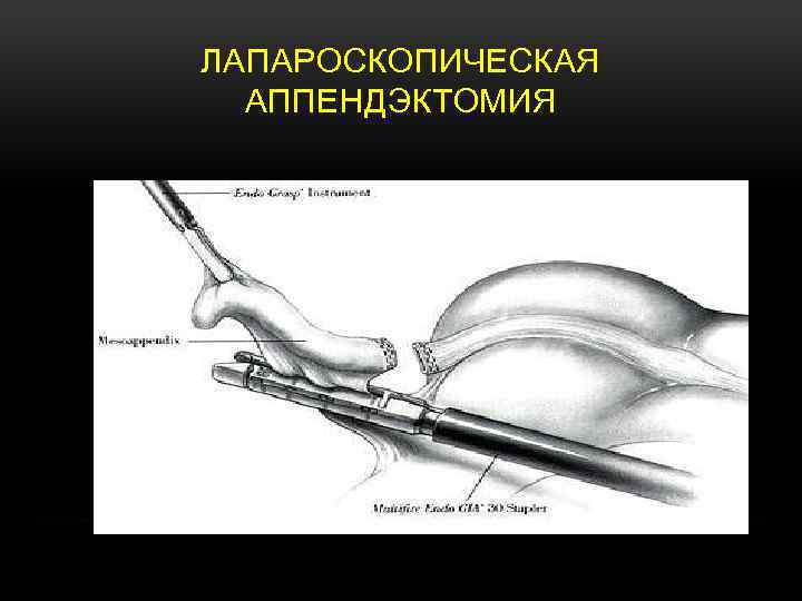 ЛАПАРОСКОПИЧЕСКАЯ АППЕНДЭКТОМИЯ 