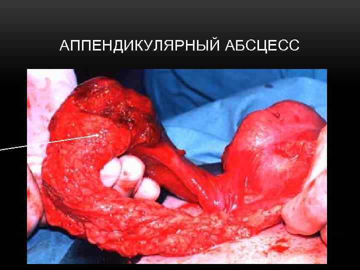 АППЕНДИКУЛЯРНЫЙ АБСЦЕСС 