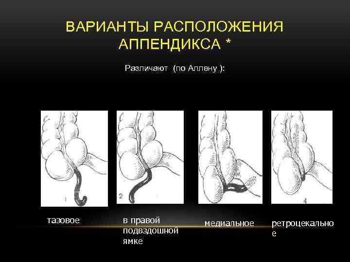 Варианты аппендикса. Ретроцекальный аппендицит. Ретроцекальный острый аппендицит. Варианты расположения аппендикса. Медиальное расположение червеобразного отростка.