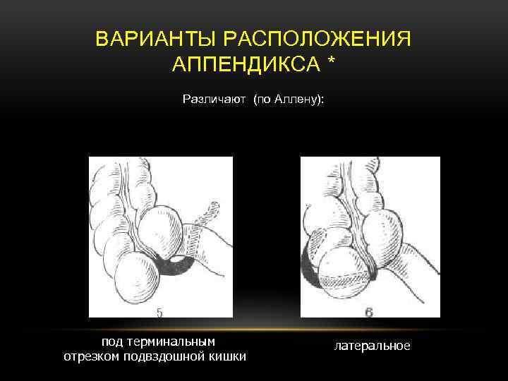 Варианты расположения червеобразного отростка схема