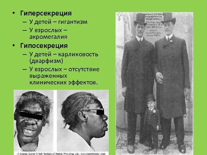  • Гиперсекреция – У детей – гигантизм – У взрослых – акромегалия •