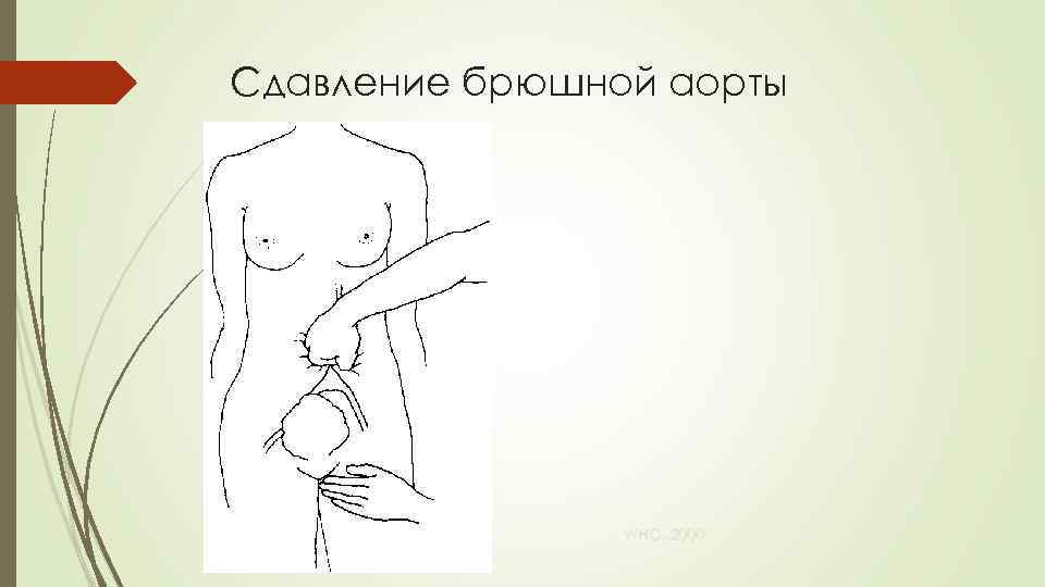 Сдавление брюшной аорты WHO, 2000 