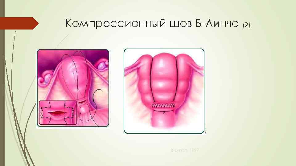 Компрессионный шов Б-Линча (2) B-Lynch, 1997 