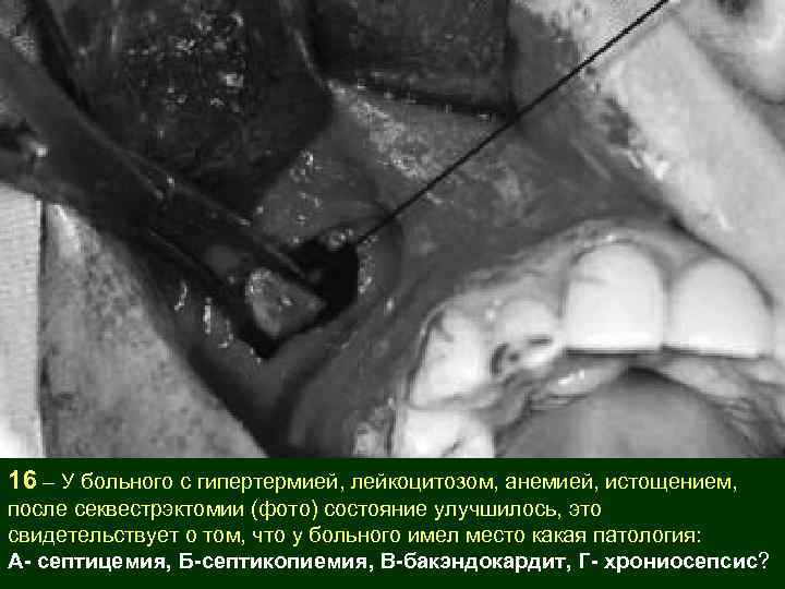 16 – У больного с гипертермией, лейкоцитозом, анемией, истощением, после секвестрэктомии (фото) состояние улучшилось,