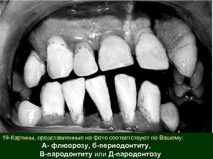 19 -Картины, представленные на фото соответствуют по Вашему: А- флюорозу, б-периодонтиту, В-пародонтиту или Д-пародонтозу