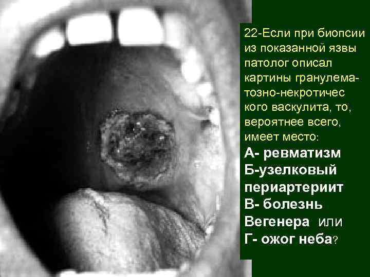22 -Если при биопсии из показанной язвы патолог описал картины гранулематозно-некротичес кого васкулита, то,