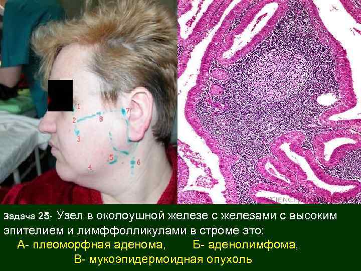 Узел в околоушной железе с железами с высоким эпителием и лимффолликулами в строме это: