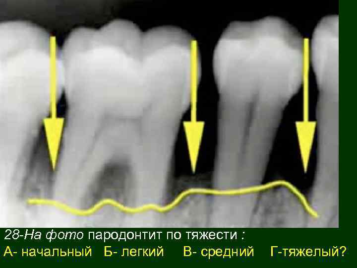 28 -На фото пародонтит по тяжести : А- начальный Б- легкий В- средний Г-тяжелый?