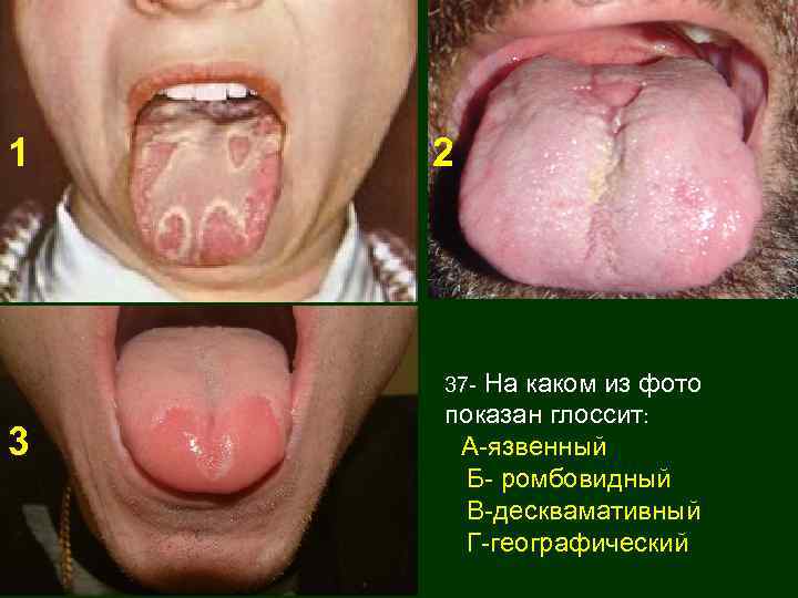 1 2 На каком из фото показан глоссит: А-язвенный Б- ромбовидный В-десквамативный Г-географический 37