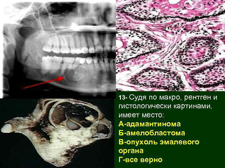 13 - Судя по макро, рентген и гистологически картинами, имеет место: А-адамантинома Б-амелобластома В-опухоль