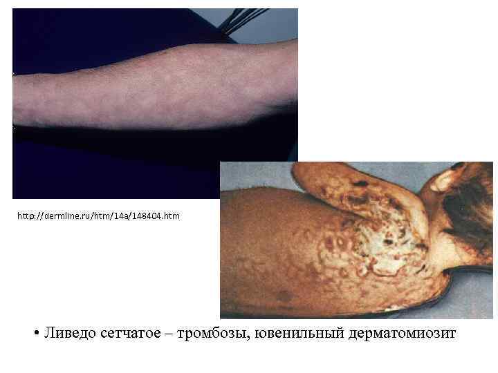 http: //dermline. ru/htm/14 a/148404. htm • Ливедо сетчатое – тромбозы, ювенильный дерматомиозит 