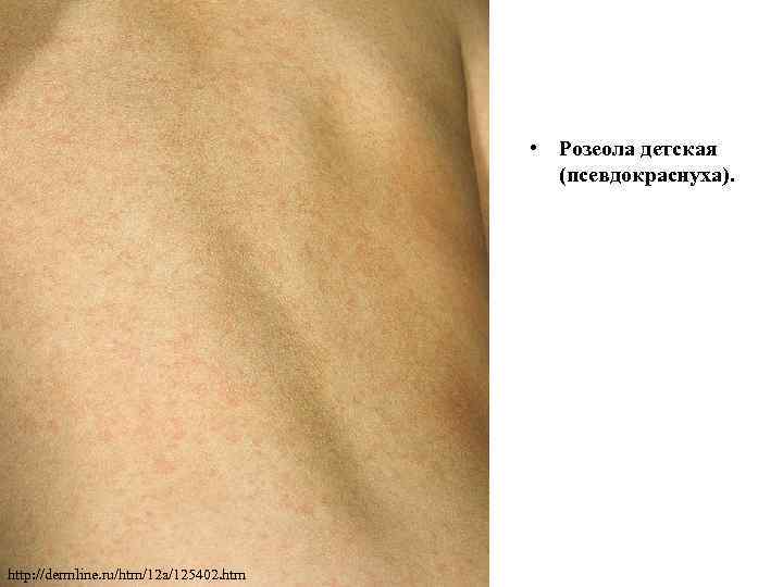  • Розеола детская (псевдокраснуха). http: //dermline. ru/htm/12 a/125402. htm 