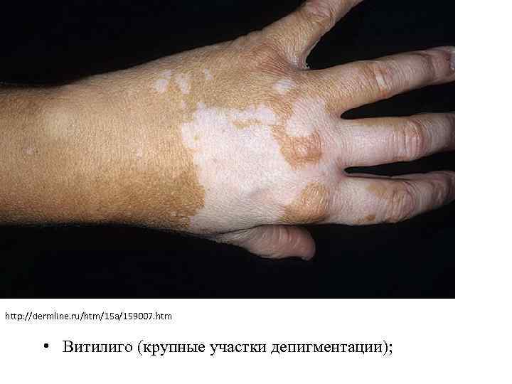 http: //dermline. ru/htm/15 a/159007. htm • Витилиго (крупные участки депигментации); 