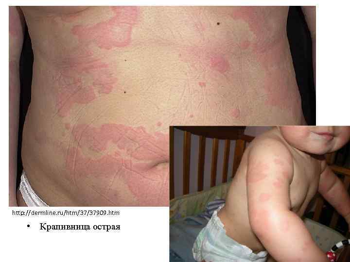 http: //dermline. ru/htm/37/37909. htm • Крапивница острая 