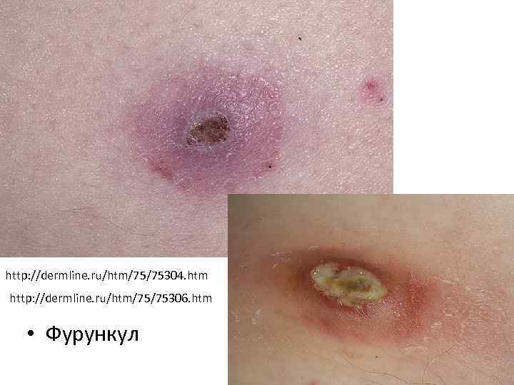 http: //dermline. ru/htm/75/75304. htm http: //dermline. ru/htm/75/75306. htm • Фурункул 