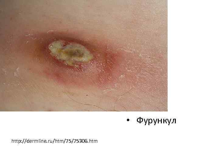  • Фурункул http: //dermline. ru/htm/75/75306. htm 