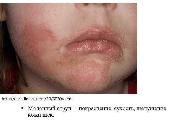 http: //dermline. ru/htm/30/30204. htm • Молочный струп – покраснение, сухость, шелушение кожи щек. 