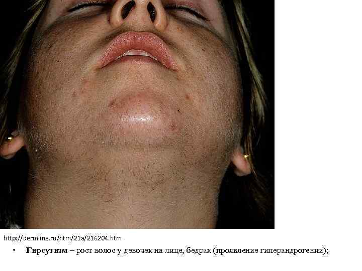 http: //dermline. ru/htm/21 a/216204. htm • Гирсутизм – рост волос у девочек на лице,